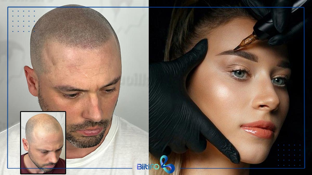 میکروپیگمنتیشن برای چه افرادی مناسب است