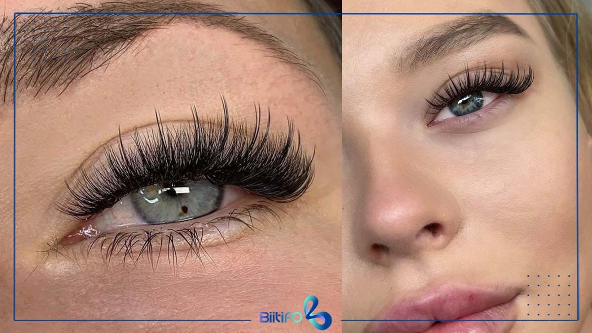 کاشت مژه هیدن هیبریدی