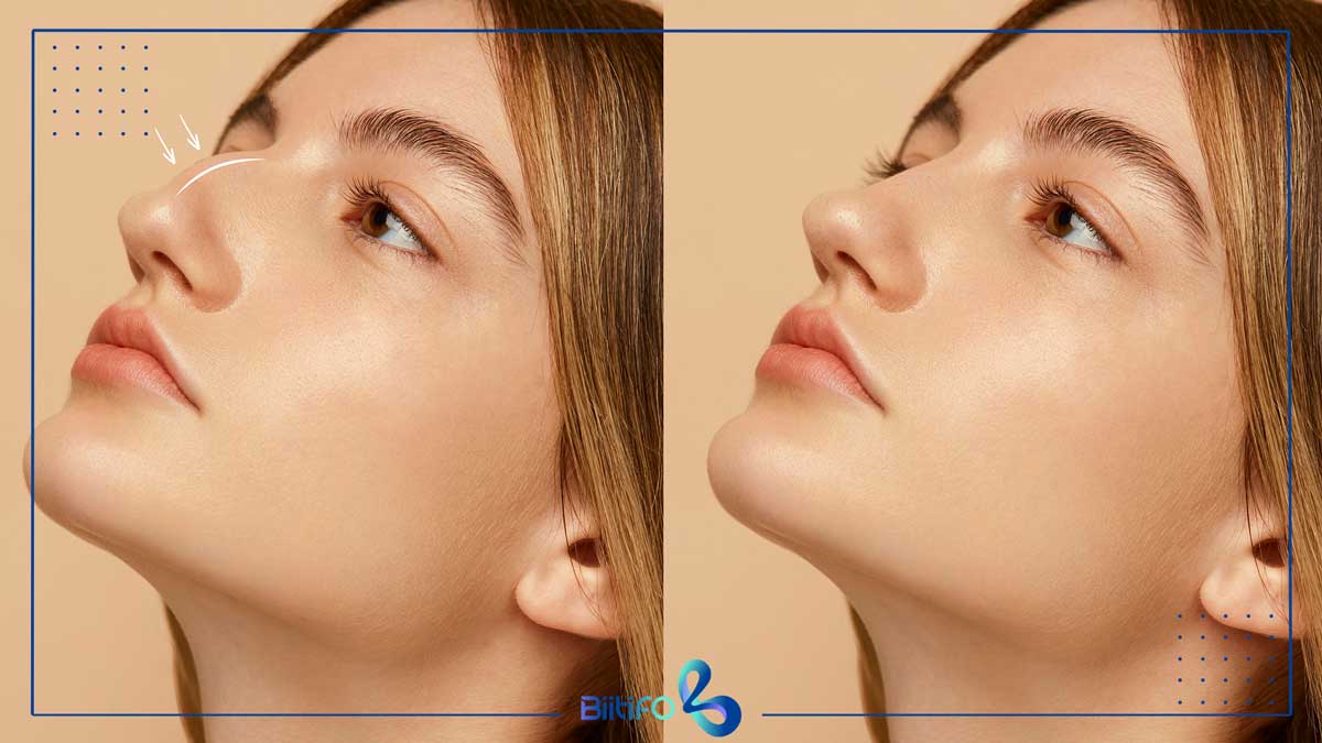 اهداف کانتورینگ برای بینی قوزدار
