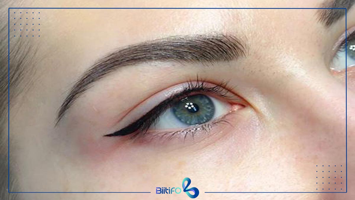 بن مژه چگونه انجام می‌شود؟