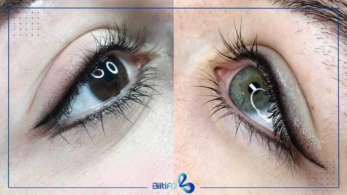 بن مژه بالا و پایین چشم