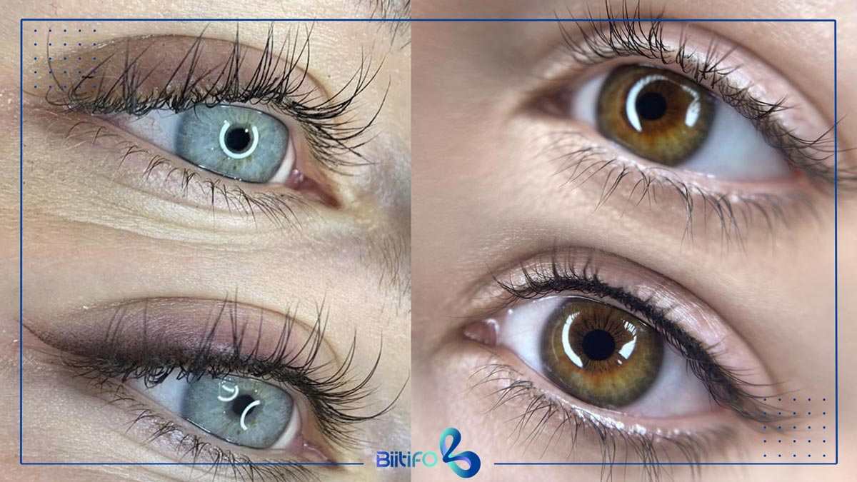  بن مژه قبل و بعد